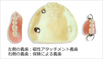 左側の義歯：磁性アタッチメント義歯右側の義歯：保険による義歯